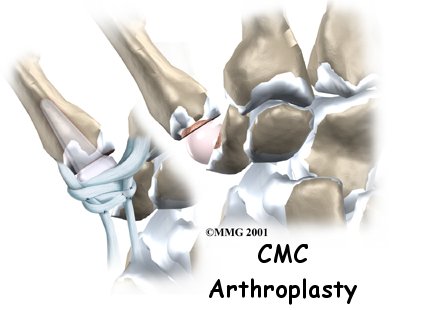 Artificial Joint Replacement of the Thumb - FYZICAL Airpark South's Guide