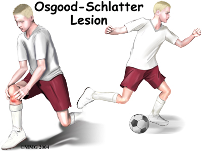 Osgood-Schlatter Disease