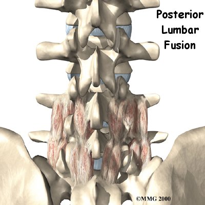 Posterior Lumbar Fusion