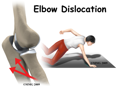 Elbow Dislocation