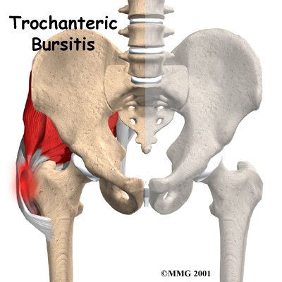 Trochanteric Bursitis of the Hip