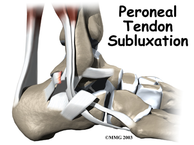 Peroneal Tendon Subluxation