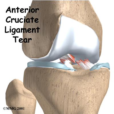 Anterior Cruciate Ligament Injuries