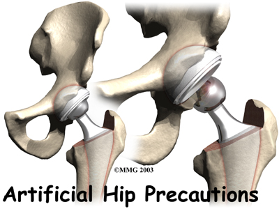 Artificial Hip Dislocation Precautions