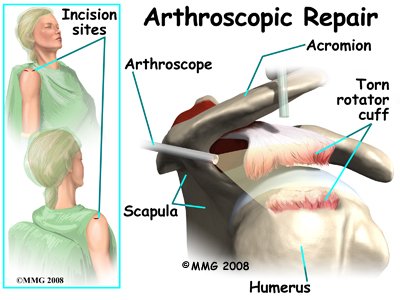 rotator cuff tendonitis recovery time