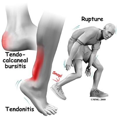 pain in bottom of achilles tendon