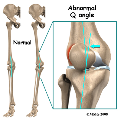 kneecap slides to the side