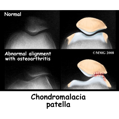 patella misaligned