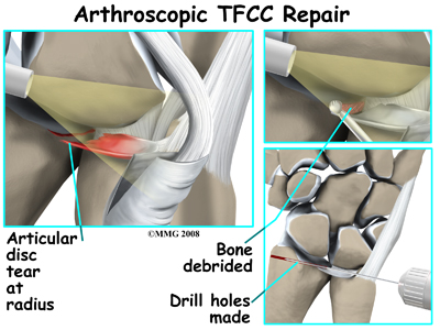 Physical Therapy in Binghamton for Triangular Fibrocartilage Complex Physical Therapy in Binghamton for Triangular Fibrocartilage Complex