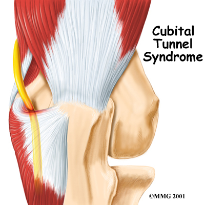 Cubital Tunnel Syndrome