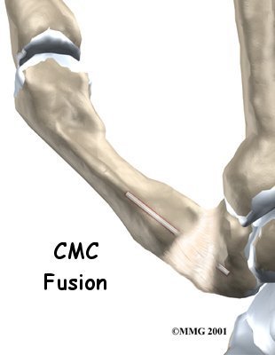 Thumb Fusion Surgery