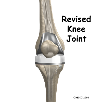 Revision Arthroplasty of the Knee