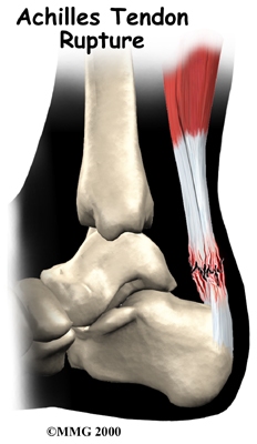 Achilles Tendon Problems Patient Guide