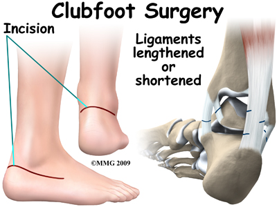 Physical Therapy In Buffalo For Pediatric Issues Clubfoot