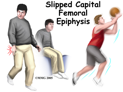 Slipped Capital Femoral Epiphysis