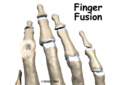 Finger Fusion Surgery - FYZICAL Camilla's Guide