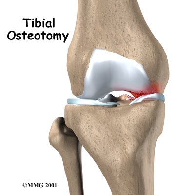 Tibial Osteotomy