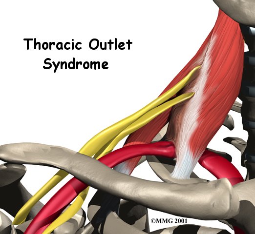 Thoracic Outlet Syndrome