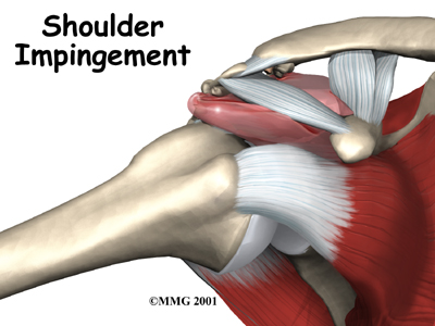 Impingement Syndrome