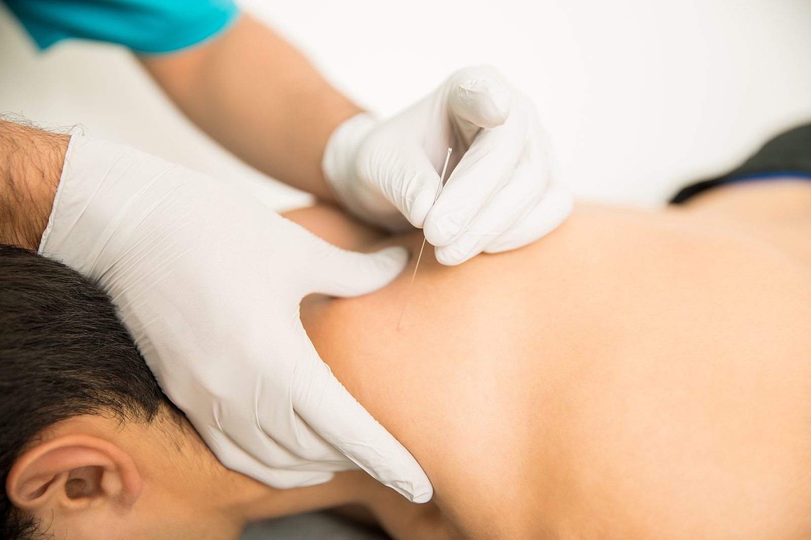 Dry Needling for Back Pain 