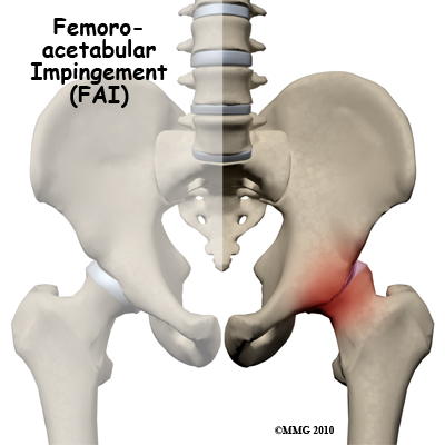 Therapy for Hip Femoroacetabular Impingement