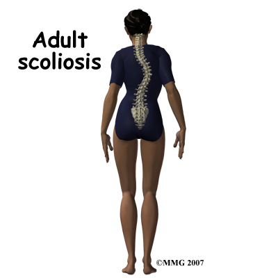 Adult Degenerative Scoliosis