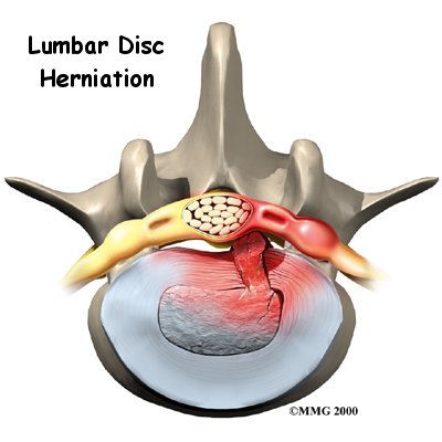 Lumbar Disc Herniation