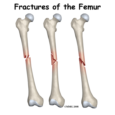 Physical Therapy in Conway for Hip - Adult Femur Fractures