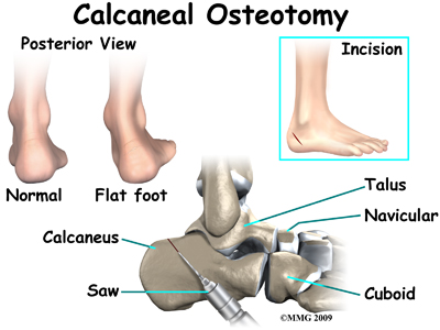 Physical Therapy in Conway for Adult Acquired Flatfoot Deformity Physical Therapy in Conway for Adult Acquired Flatfoot Deformity