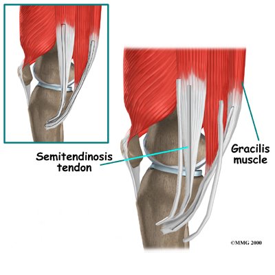 Physical Therapy In Conway For Hamstring Tendon Graft Reconstr