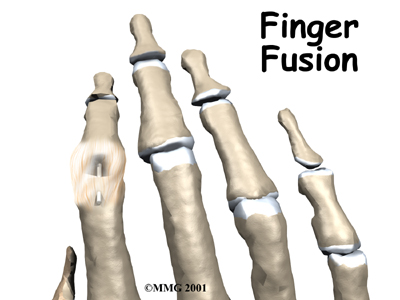 Finger Fusion Surgery - FYZICAL Doylestown's Guide