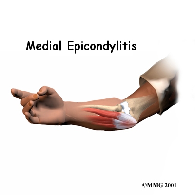 Golfers Elbow (Medial Epicondylitis)