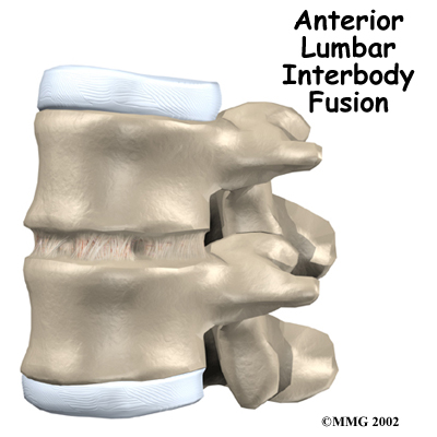 Anterior Lumbar Interbody Fusion