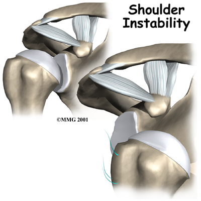 Shoulder Instability