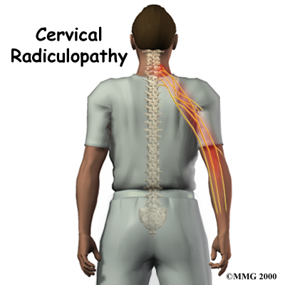 Cervical Radiculopathy