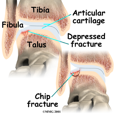 gallér osteochondrosis kenőcsök és tabletták ízületi fájdalmakra