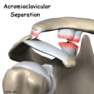 Acromioclavicular Joint Separation