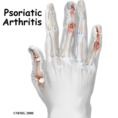 Psoriatic arthritis causes what Psoriatic arthritis: