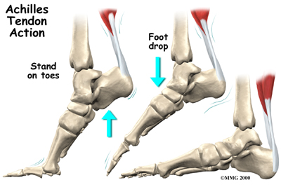 achilles tendon pain walking