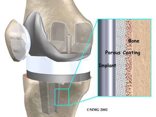 Physical Therapy In Lansing For Knee Revision Arthroplasty