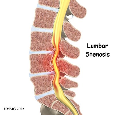 Lumbar Spinal Stenosis