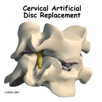 Cervical Artificial Disc Replacement