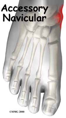 Accessory Navicular Problems