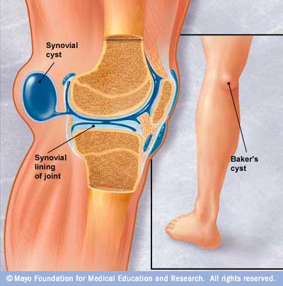 FYZICAL Forest Hill Baker s Cyst Causes and Symptoms for Treatment