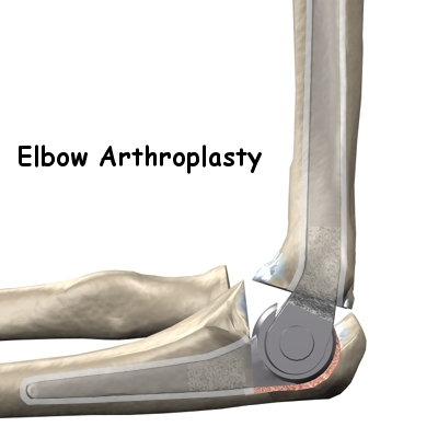 Artificial Joint Replacement