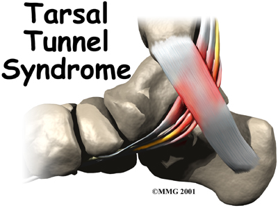 Tarsal Tunnel Syndrome