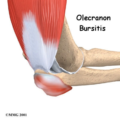 Olecranon Bursitis