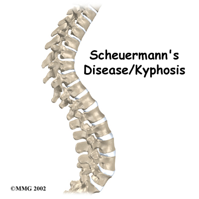 Scheuermann's Disease