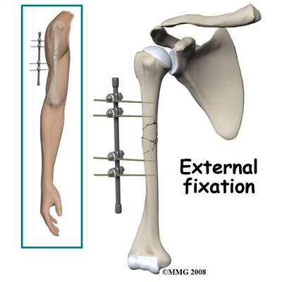 Physical Therapy In Grove City For Adult Humerus Fracture
