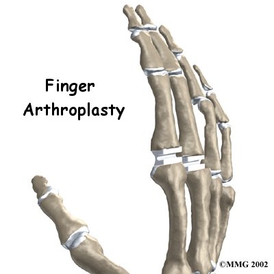 Artificial Joint Replacement of the Finger - FYZICAL Highlands Ranch's Guide